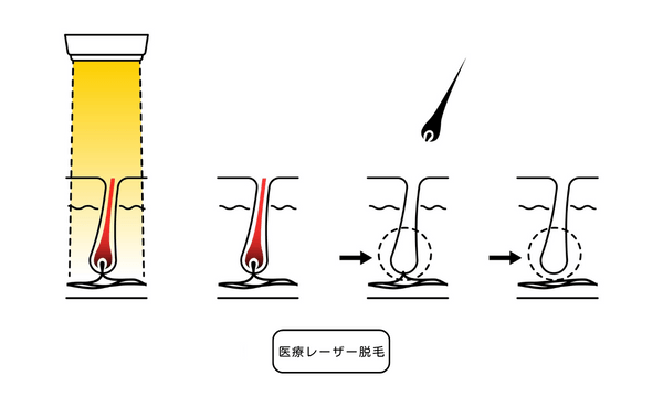 医療レーザー脱毛