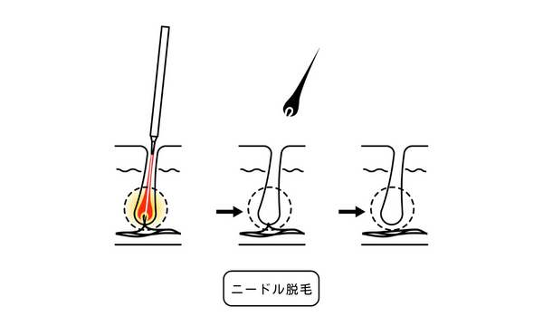 ニードル脱毛