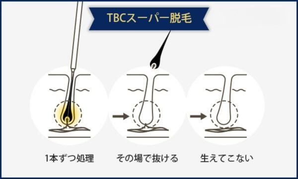 TBCのスーパー脱毛の図解