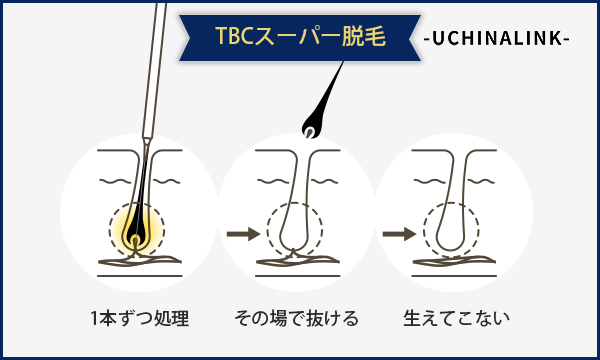 スーパー脱毛(美容電気脱毛)