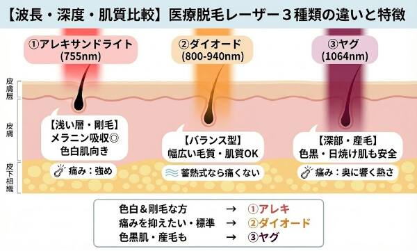 医療脱毛レーザー3種類の違いと特徴の図解