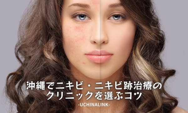 沖縄でニキビ・ニキビ跡治療のクリニックを選ぶコツ